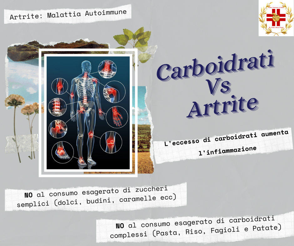 Tra le malattie autoimmuni più diffuse c'è l'artrite, dovuta alle cellule del sistema immunitario che colpiscono le cellule delle cartilagini e di altri tessuti perché le riconoscono "estranee" e perciò potenzialmente pericolose. Una dieta caratterizzata dal consumo eccessivo di carboidrati aumenta l'infiammazione corporea e l'attività immunitaria, che a loro volta contribuiscono ad aggravare tale malattia, la cui sintomatologia è avvertita anche a livello dell'intestino, a causa del disequilibrio che si instaura tra i batteri presenti. Cosa fare? 2 semplici passi: dieta equilibrata + ripristino dei batteri intestinali. In questo modo si ripristina l'integrità della parete dell'intestino tenue e si riducono l'infiammazione e l'intensità degli altri sintomi.